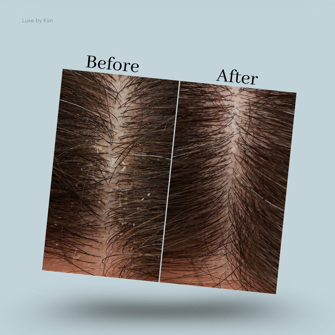 Before and after comparison of a flaky scalp; the "before" image shows significant dandruff, while the "after" image shows a much clearer scalp.