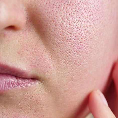 Pores